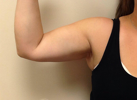 CoolSculpting, John W. Decorato, M.D., FACS, Staten Island, NY