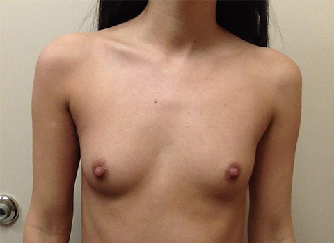 before breast augmentation in staten island