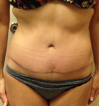Liposuction, John W. Decorato, M.D., FACS, Staten Island, NY