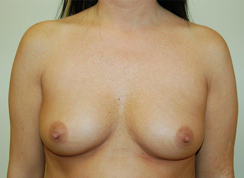 before breast augmentation in staten island