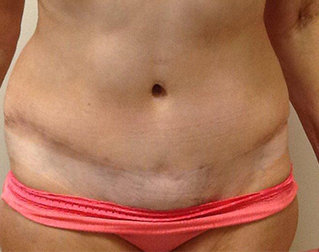 Liposuction, John W. Decorato, M.D., FACS, Staten Island, NY