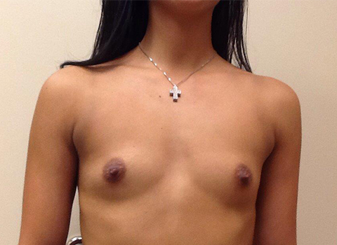 before breast augmentation in staten island