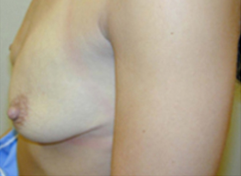 before breast augmentation in staten island