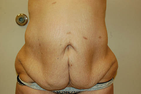 Tummy Tuck, John W. Decorato, M.D., FACS, Staten Island, NY