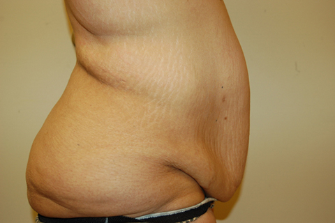Tummy Tuck, John W. Decorato, M.D., FACS, Staten Island, NY