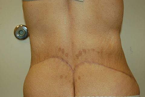 Tummy Tuck, John W. Decorato, M.D., FACS, Staten Island, NY