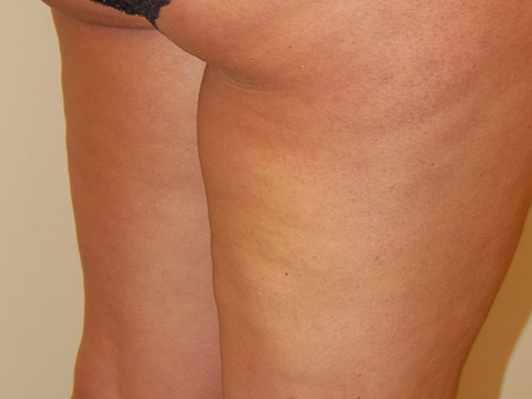 after cellulaze treatment pictures in staten island nyc