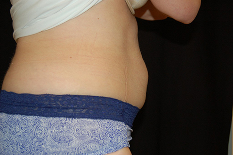 CoolSculpting, John W. Decorato, M.D., FACS, Staten Island, NY
