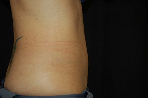 CoolSculpting, John W. Decorato, M.D., FACS, Staten Island, NY