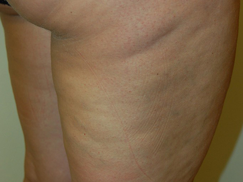 before cellulaze treatment pictures in staten island nyc