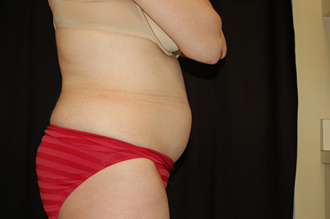 CoolSculpting, John W. Decorato, M.D., FACS, Staten Island, NY