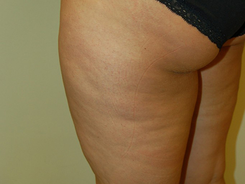 before cellulaze treatment pictures in staten island nyc