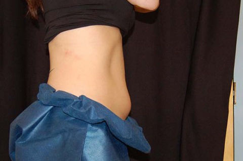CoolSculpting, John W. Decorato, M.D., FACS, Staten Island, NY