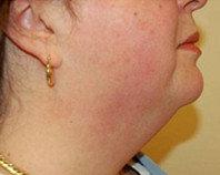 before neck lift pictures in staten island nyc