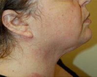 after neck lift pictures in staten island nyc