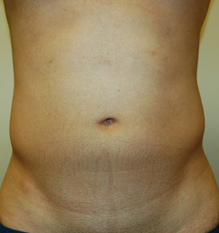 Liposuction, John W. Decorato, M.D., FACS, Staten Island, NY