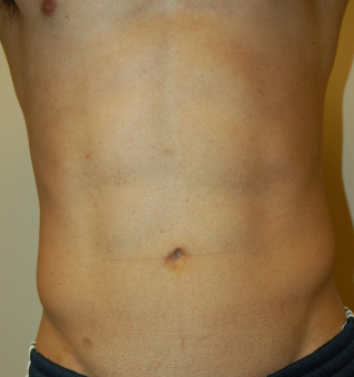 Liposuction, John W. Decorato, M.D., FACS, Staten Island, NY