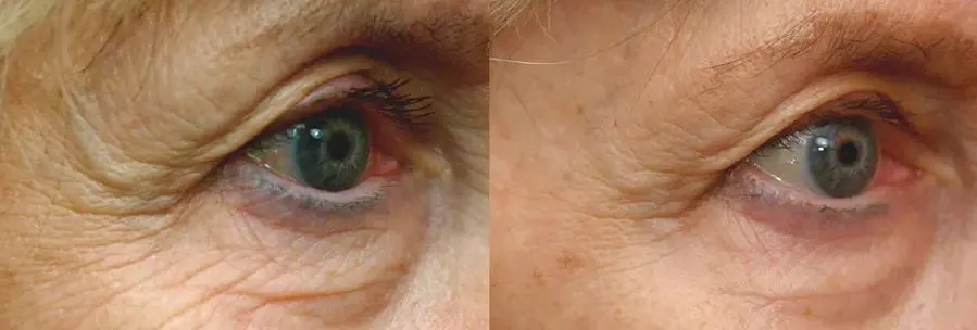 Pelleve Before and After Pictures Staten Island, NY