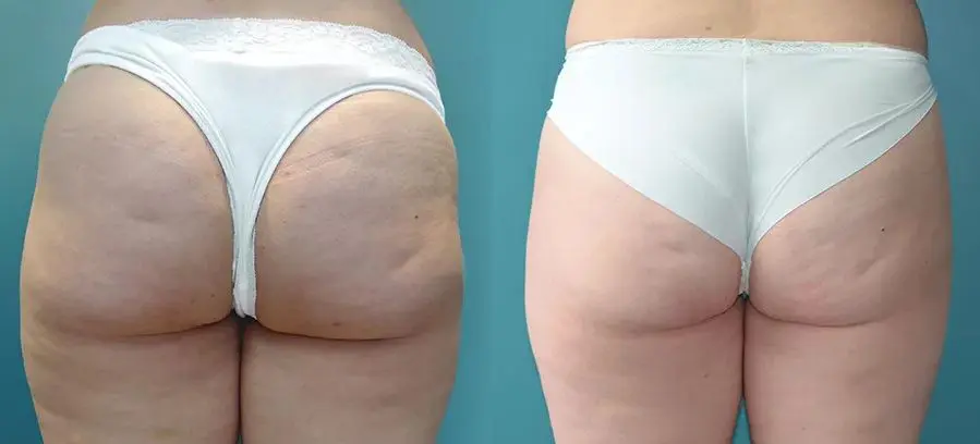 Pelleve Before and After Pictures Staten Island, NY