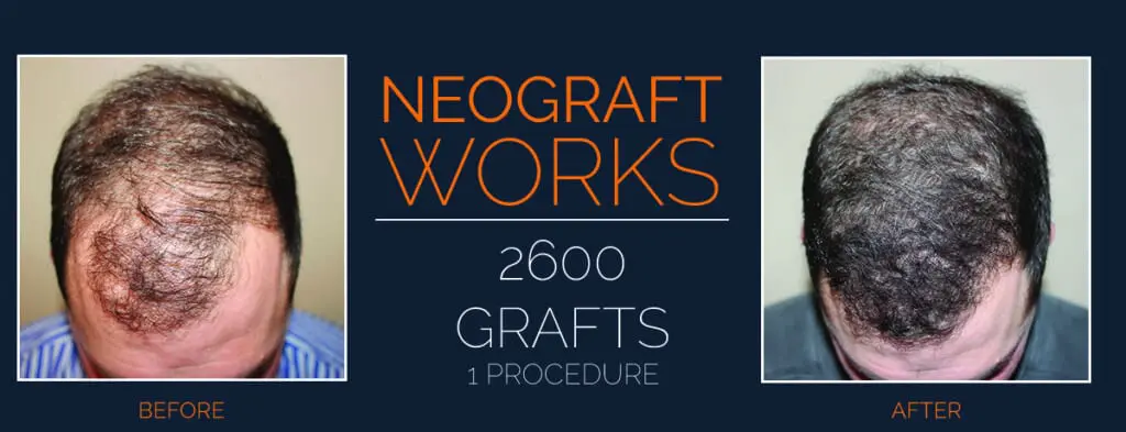 NeoGraft® Before and After Staten Island, NY