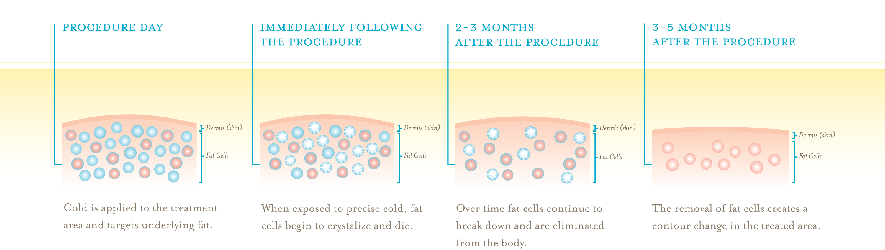 Coolsculpting Staten Island Cost Coolsculpting Staten Island Cost