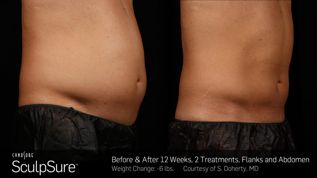 SculpSure Before and After Pictures Staten Island, NY