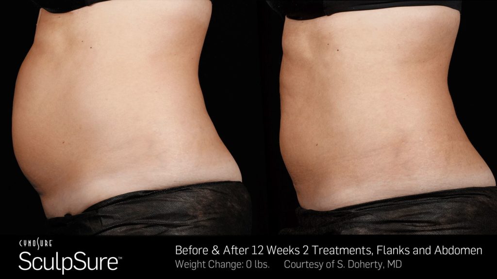 SculpSure Before and After Pictures Staten Island, NY