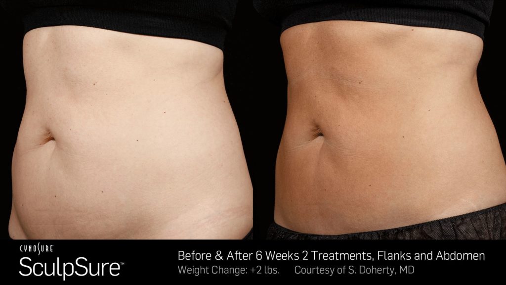 SculpSure Before and After Pictures Staten Island, NY