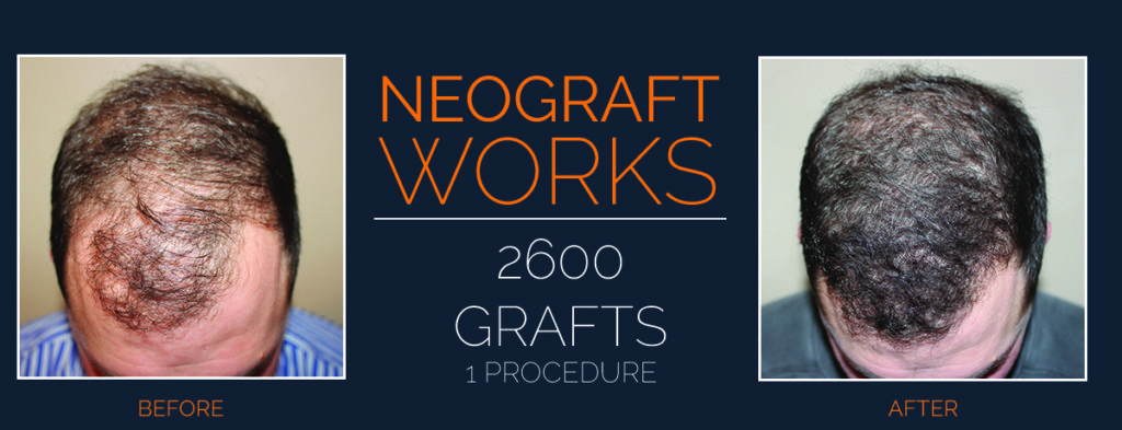NeoGraft® Before and After Staten Island, NY