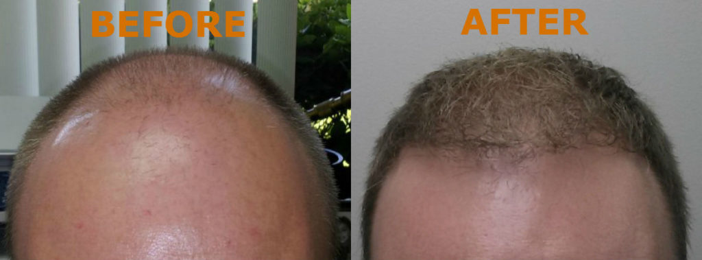 NeoGraft® Before and After Staten Island, NY