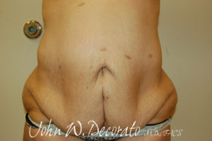 Tummy Tuck Before and After Pictures Staten Island, NY