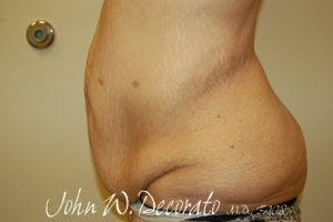 Tummy Tuck Before and After Pictures Staten Island, NY