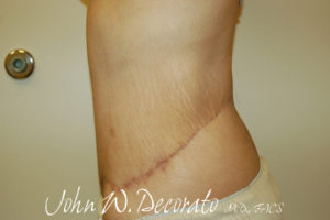 Tummy Tuck Before and After Pictures Staten Island, NY