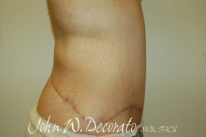 Tummy Tuck Before and After Pictures Staten Island, NY