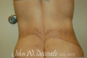 Tummy Tuck Before and After Pictures Staten Island, NY