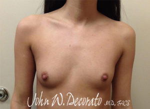 Breast Augmentation Before and After Pictures Staten Island, NY