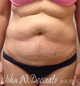 Liposuction Before and After Pictures Staten Island, NY