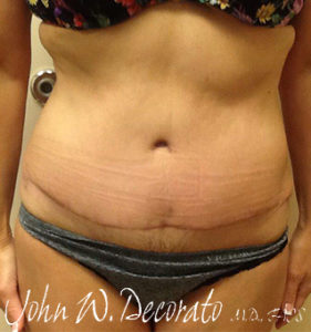 Liposuction Before and After Pictures Staten Island, NY