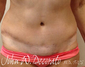 Liposuction Before and After Pictures Staten Island, NY