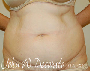 Liposuction Before and After Pictures Staten Island, NY