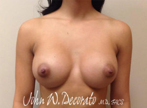 Breast Augmentation Before and After Pictures Staten Island, NY