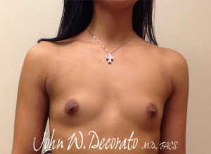 Breast Augmentation Before and After Pictures Staten Island, NY