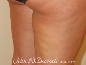 Cellulaze Before and After Pictures Staten Island, NY