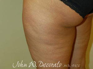 Cellulaze Before and After Pictures Staten Island, NY
