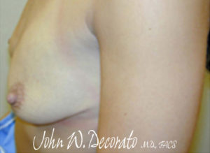 Breast Augmentation Before and After Pictures Staten Island, NY