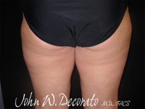 CoolSculpting Before and After Pictures Staten Island, NY