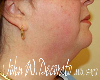 Neck Lift Before and After Pictures Staten Island, NY