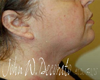 Neck Lift Before and After Pictures Staten Island, NY