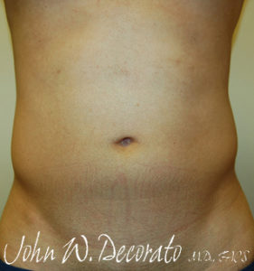 Liposuction Before and After Pictures Staten Island, NY