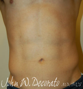 Liposuction Before and After Pictures Staten Island, NY